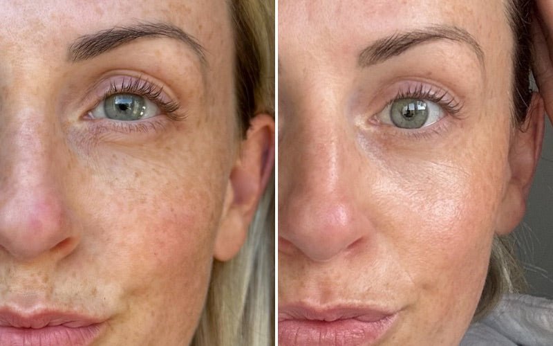 Before and after comparison of a woman's face with visible skin texture and acne on the left, and smoother skin on the right.