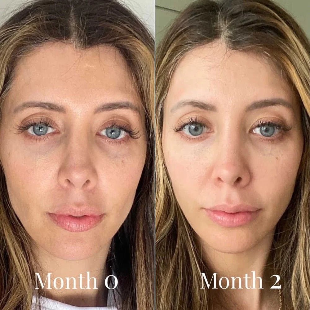 Before and after comparison of a woman's face with text labels 'Month 0' and 'Month 2'.