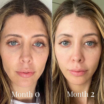 Before and after comparison of a woman's face with text labels 'Month 0' and 'Month 2'.